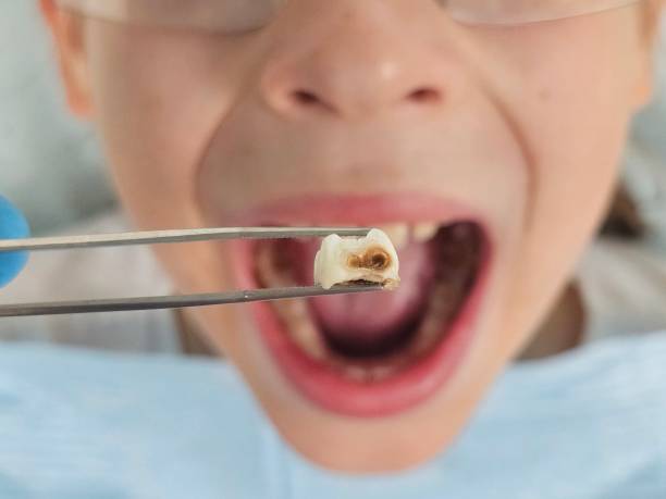 Best Emergency Wisdom Teeth Removal in Austell, GA